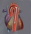 Bolesti grudne aorte