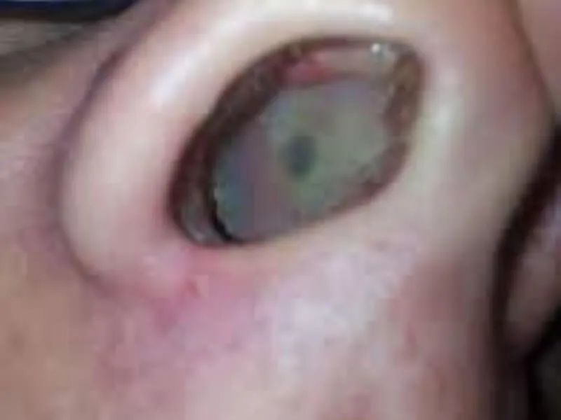 Perforacija nosne pregrade