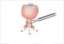 Loop dijatermija (Loop Electrosurgical Excision Procedure - LEEP)