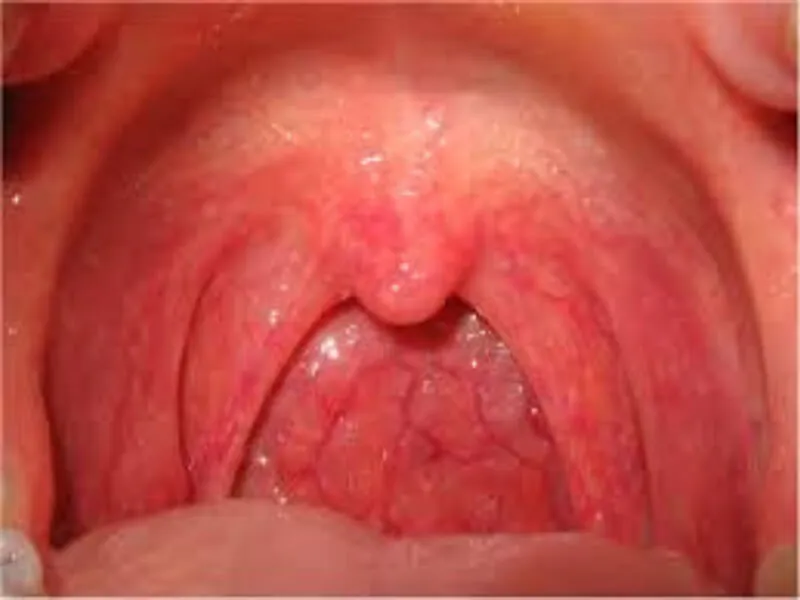 Pseudokrup