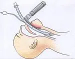 Intubaciona trauma larinksa