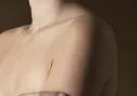 Adhezivni kapsulitis