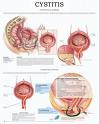 Cistitis