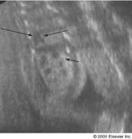 Adrenogenitalni Sindrom