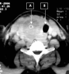 Akutni bakterijski tireoiditis