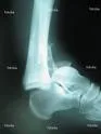 Iščašenje skočnog zgloba (luxatio articulatio talocruralis)