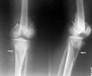 Interkondilarni prelomi butne kosti (Fractura intercondylaris femoris)