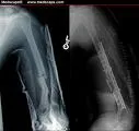 Prelomi dijafize humerusa (Fractura diaphyseos humeri)