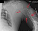 Prelomi gornjeg okrajka humerusa
