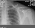 Prelomi ključne kosti (Fractura claviculae)