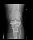 Prelomi kondila tibije (Fractura condily tibiae)