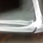 Prelomi olekranona (Fractura olecrani)
