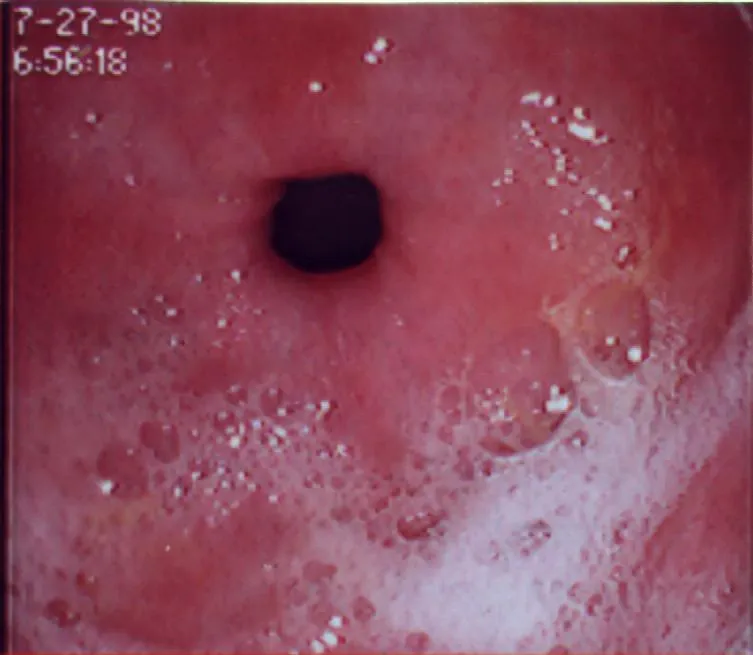 Postoperativni refluks gastritis