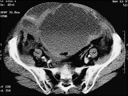 Hematom ovojnice M. Rectus Abdominisa