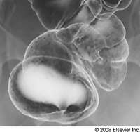 Holecistoduodenalna Fistula