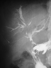 Holedohoduodenalna Fistula