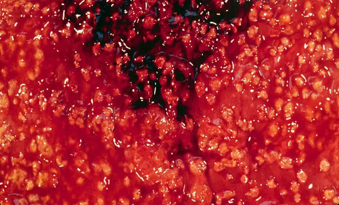 Pseudomembranozni Kolitis
