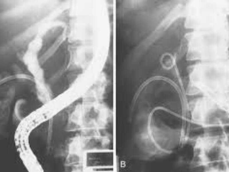 Hemobilija