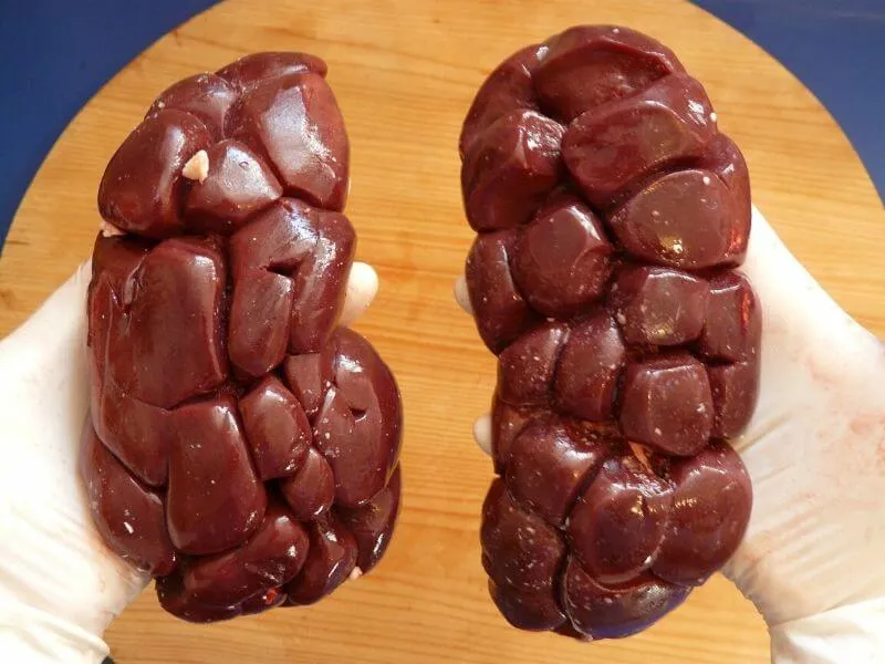 Povrede bubrega