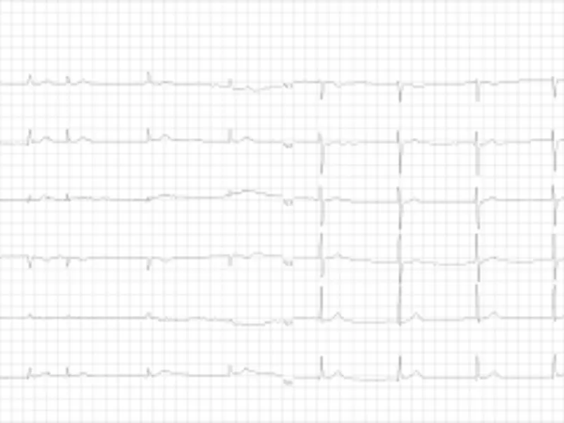 Bolest sinusnog čvora (sick sinus syndrome)