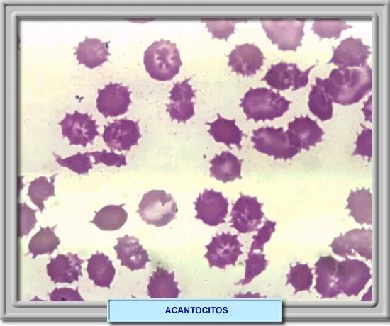 Abetalipoproteinemia