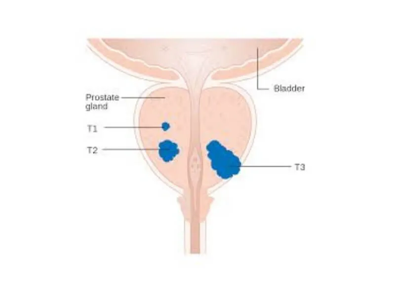 Nove metode u lečenju raka prostate